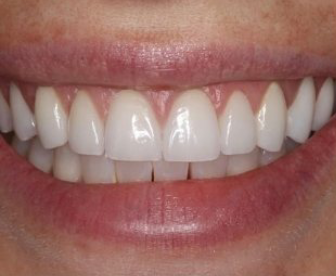 after cosmetic dental treatment providing an even smile from dentist near you