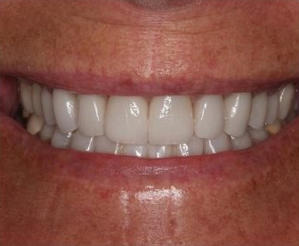 after full mouth dental restoration completed at dental clinic near you