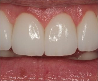 after smile transformation showing restored bright teeth by dentist near you