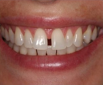 before cosmetic dental treatment case at dental clinic nw calgary, ab