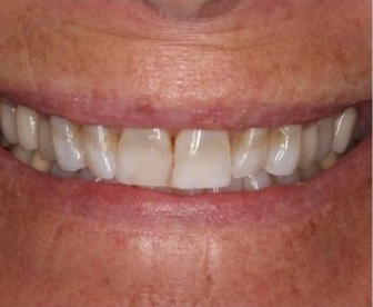 before full mouth dental restoration case at dentist nw calgary, ab