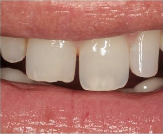 before smile transformation showing worn teeth at dental clinic nw calgary, ab