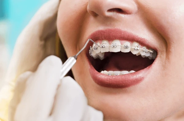 dental braces near you