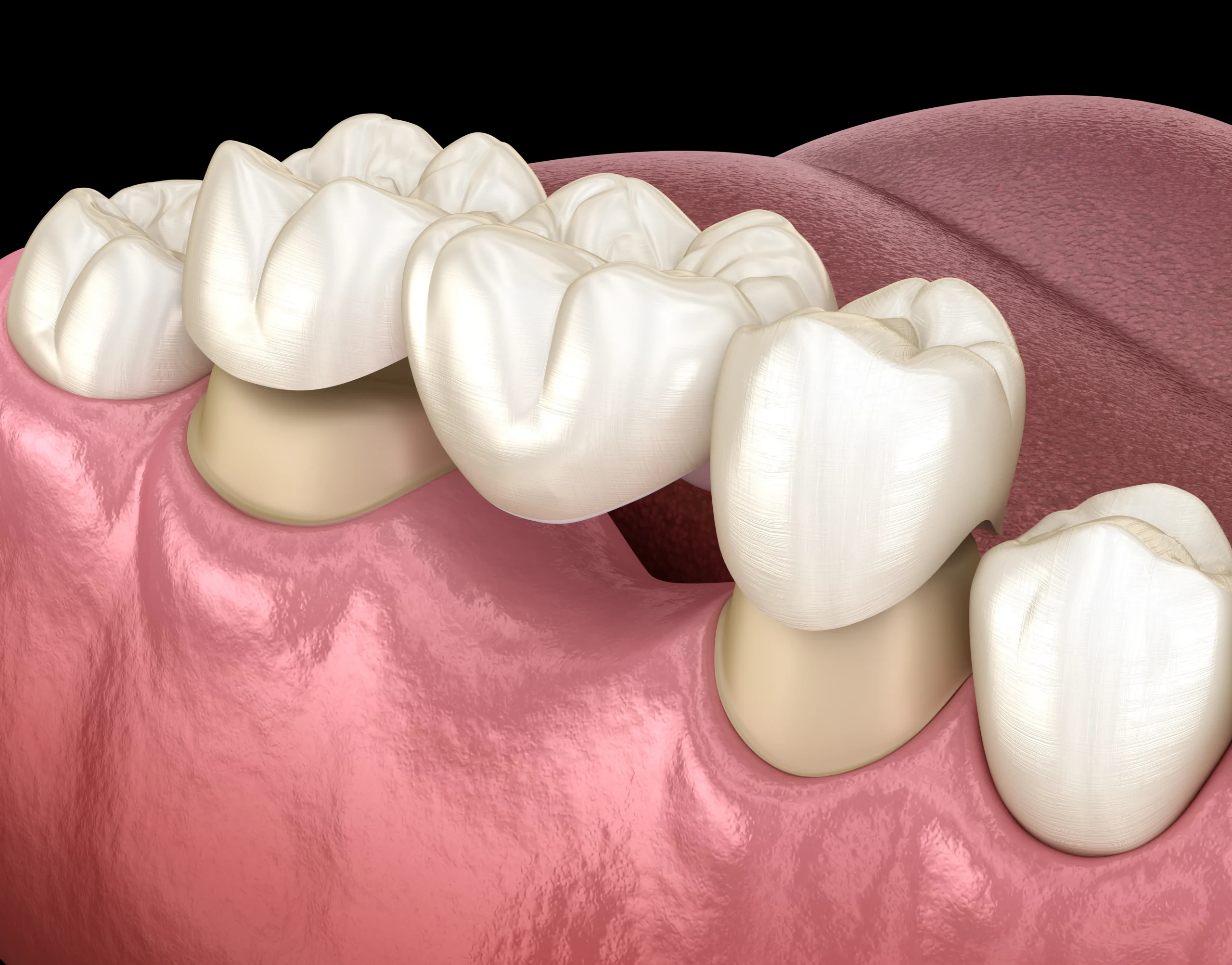 dental bridges near you