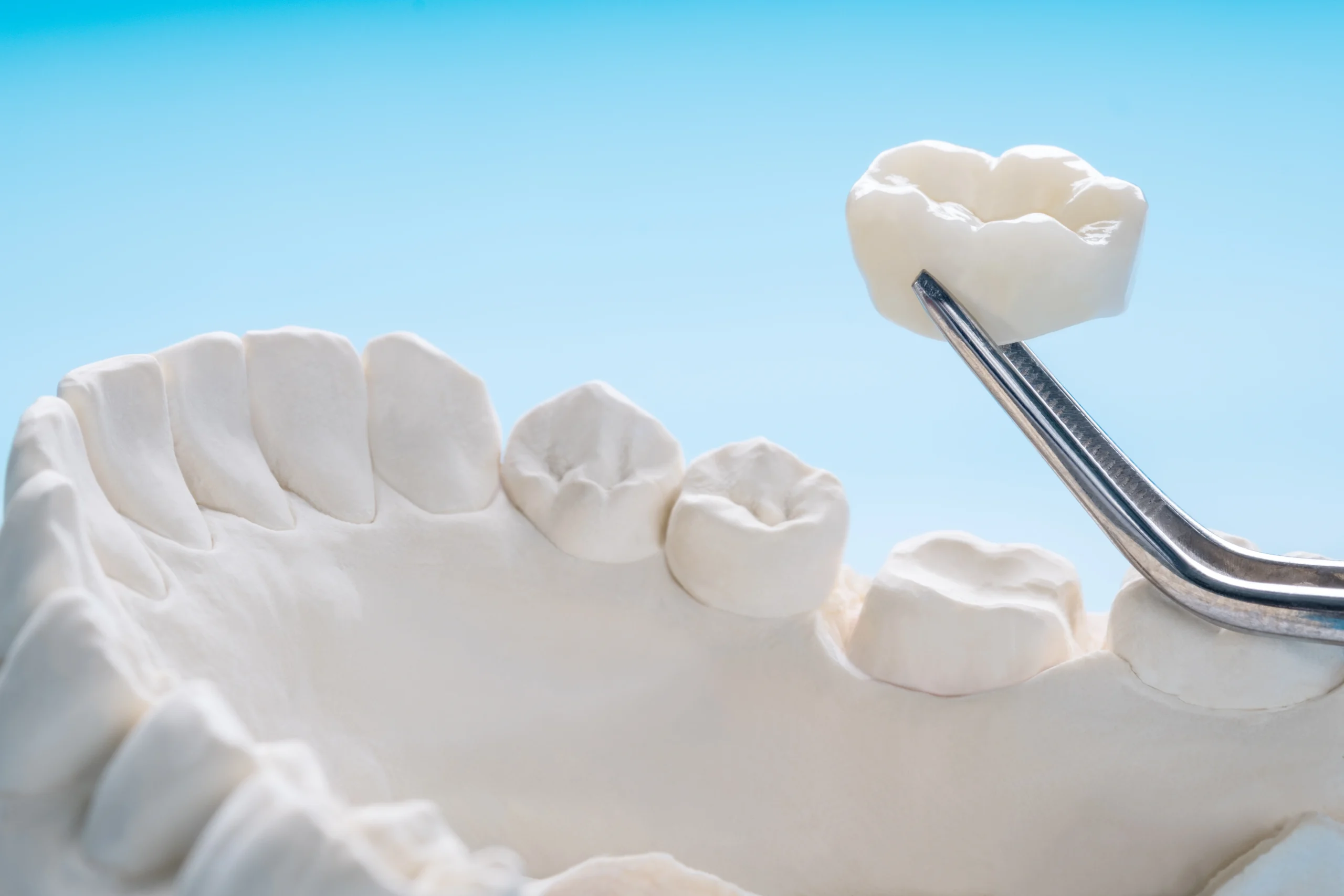 dental crowns in nw calgary