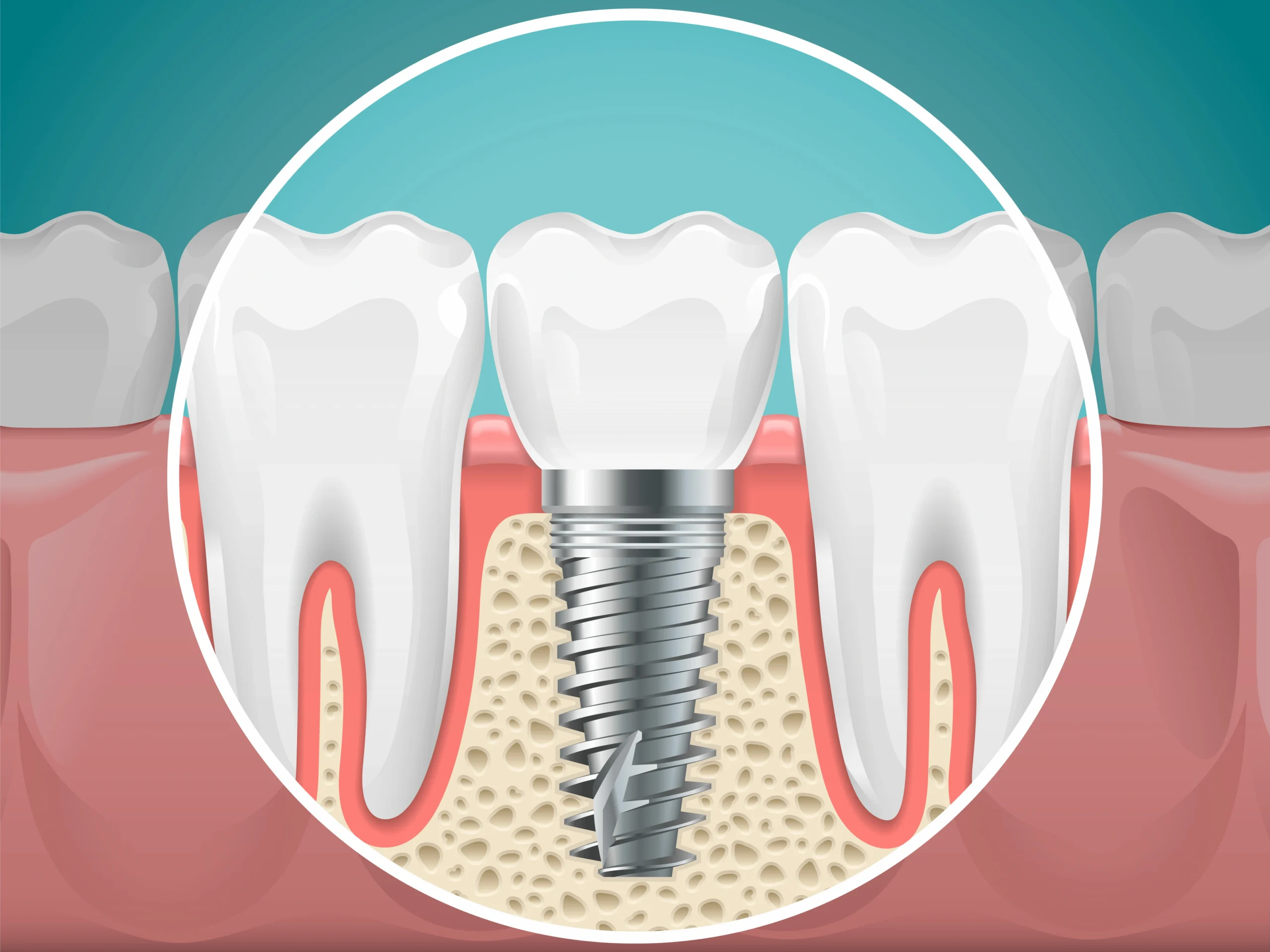 dental implants in nw calgary