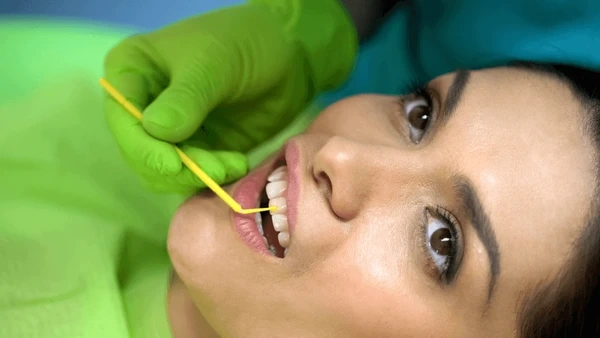 dental sealants near you