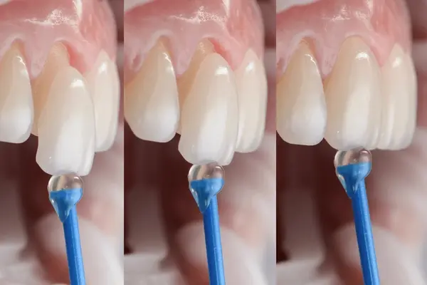dental veneers in nw calgary