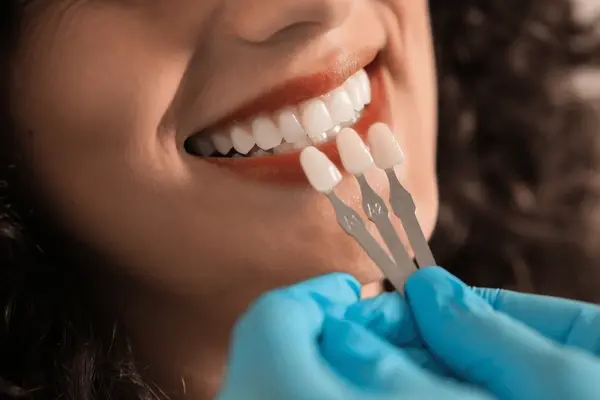 dental veneers near you