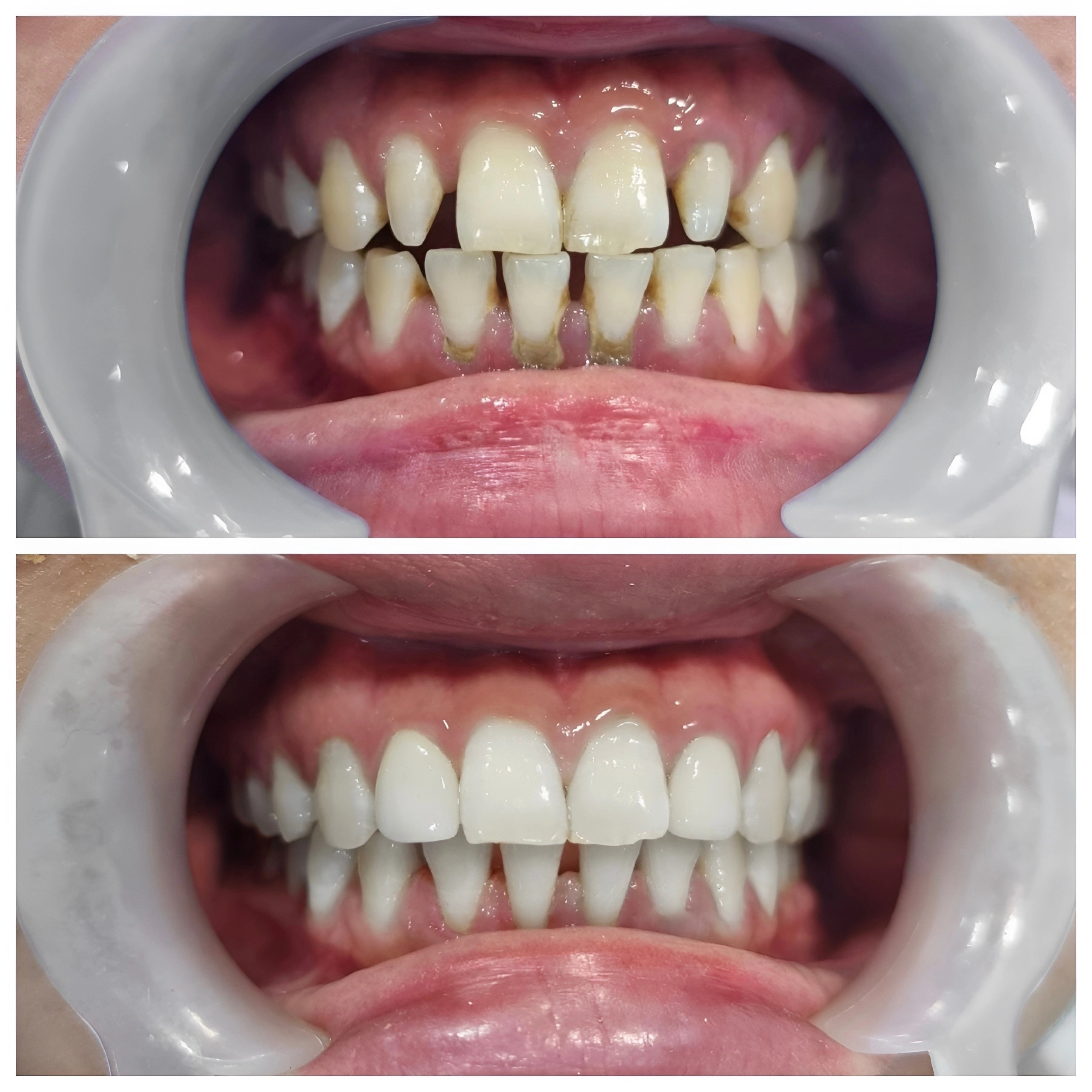 full mouth rehabilitation in nw calgary