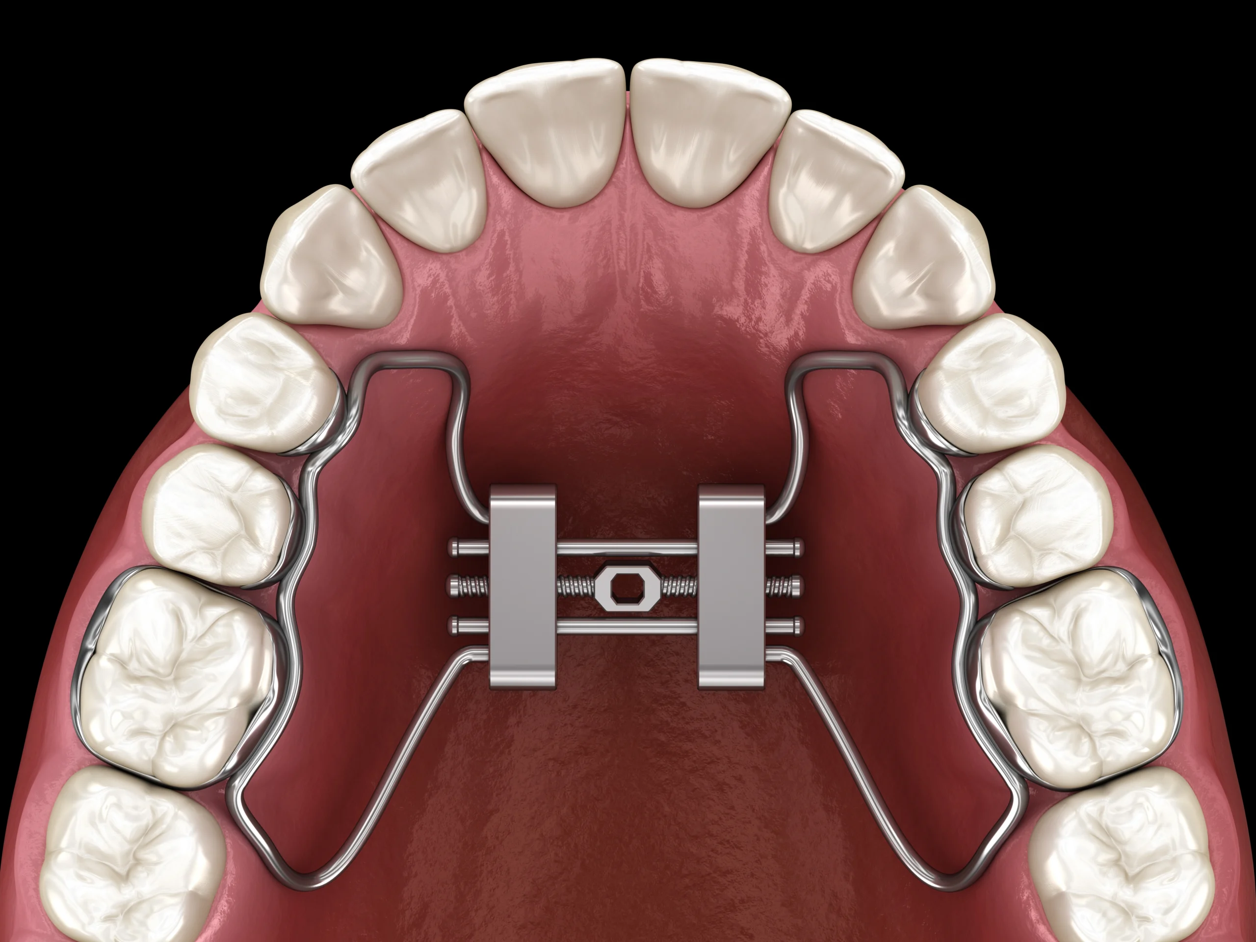 orthodontics and bite optimization in nw calgary