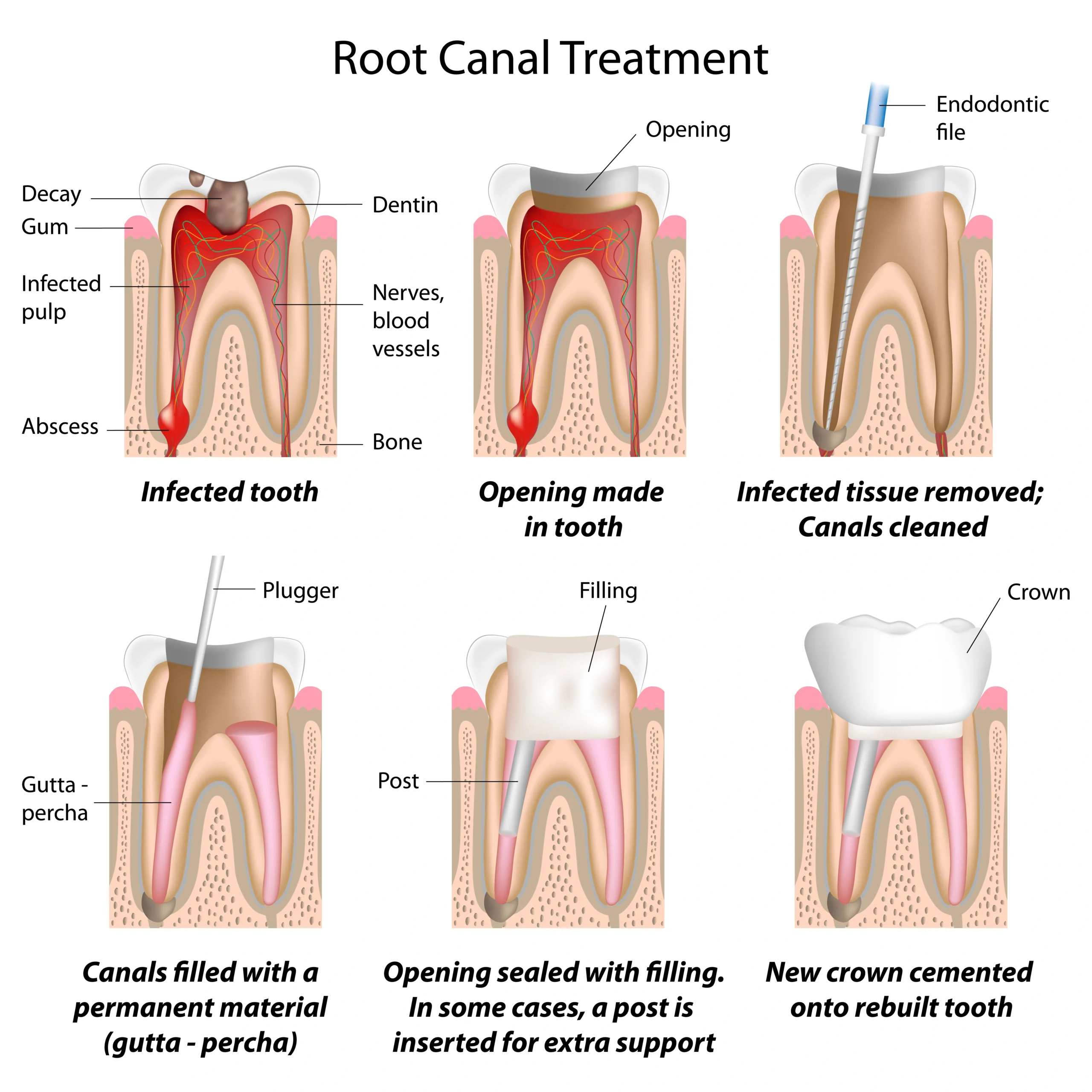 root canal therapy in nw calgary