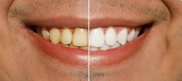 teeth whitening in nw calgary
