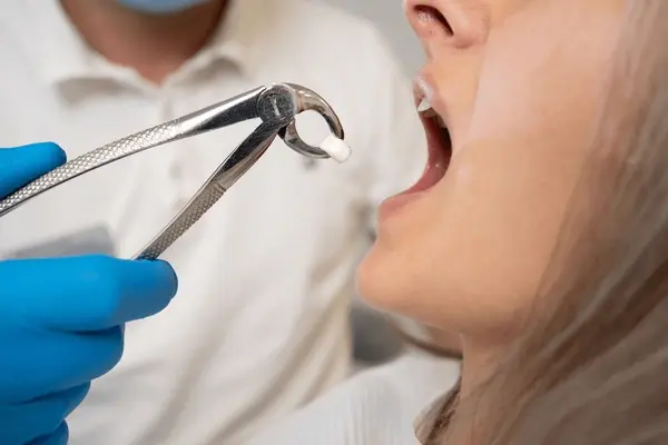 tooth extractions in nw calgary