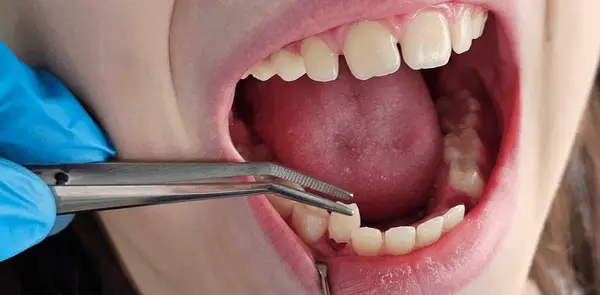 tooth extractions near you